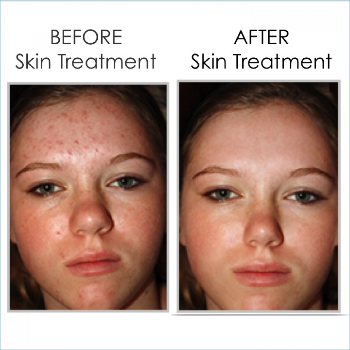 VisaoMD Peel - Acne (2)