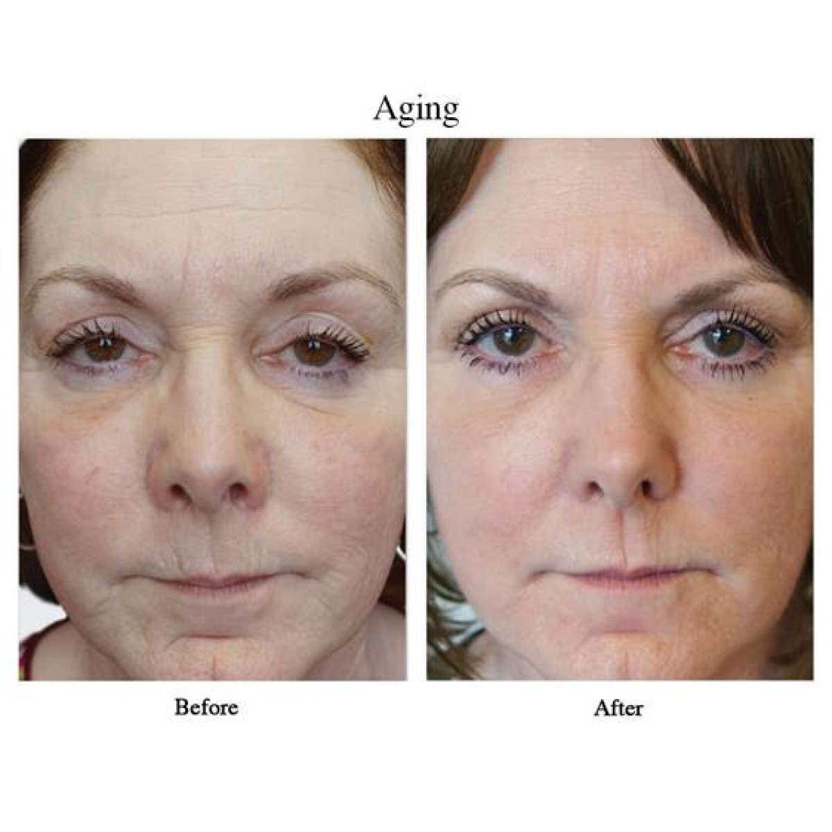 VisaoMD Peel - Aging