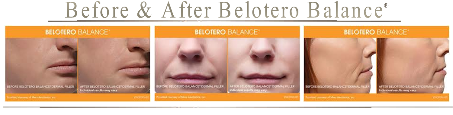 Before-and-After-Belotero-Balance-with-Platinum-Mobile-Medspa