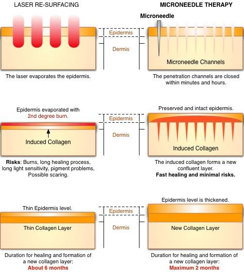 Microneedling vs. laser